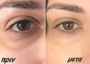 Δερματολόγος Σκύδρα, αφροδισιολόγος Σκύδρα, δερματοσκόπηση Σκύδρα, χειρουργική αφαίρεση σπίλων Σκύδρα, laser αποτρίχωση Σκύδρα, κρυοχειρουργική Σκύδρα, υαλουρονικό οξύ Σκύδρα, μεσοθεραπεία Σκύδρα, Θεοφάνους 