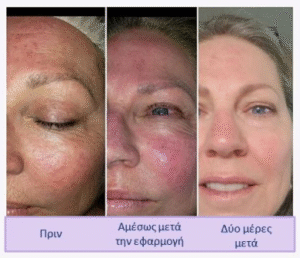 Δερματολόγος Σκύδρα, αφροδισιολόγος Σκύδρα, δερματοσκόπηση Σκύδρα, χειρουργική αφαίρεση σπίλων Σκύδρα, laser αποτρίχωση Σκύδρα, κρυοχειρουργική Σκύδρα, υαλουρονικό οξύ Σκύδρα, μεσοθεραπεία Σκύδρα, Θεοφάνους 