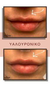 Δερματολόγος Θεσσαλονίκη, αφροδισιολόγος Θεσσαλονίκη, botox Θεσσαλονίκη, laser αλεξανδρίτης Θεσσαλονίκη, lifting Θεσσαλονίκη, μεσοθεραπεία Θεσσαλονίκη, υαλουρονικό χειλιών Θεσσαλονίκη, Ιωσηφίδου