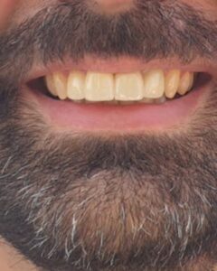 Οδοντίατρος Ρόδος, οδοντιατρείο Ρόδος, σφραγίσματα Ρόδος, λεύκανση δοντιών Ρόδος, εμφυτεύματα Ρόδος, όψεις πορσελάνης Ρόδος, προσθετική δοντιών Ρόδος, Μιχαλάκης