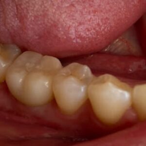 Οδοντίατρος Ρόδος, οδοντιατρείο Ρόδος, σφραγίσματα Ρόδος, λεύκανση δοντιών Ρόδος, εμφυτεύματα Ρόδος, όψεις πορσελάνης Ρόδος, προσθετική δοντιών Ρόδος, Μιχαλάκης