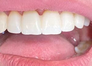 Οδοντίατρος Ρόδος, οδοντιατρείο Ρόδος, σφραγίσματα Ρόδος, λεύκανση δοντιών Ρόδος, εμφυτεύματα Ρόδος, όψεις πορσελάνης Ρόδος, προσθετική δοντιών Ρόδος, Μιχαλάκης