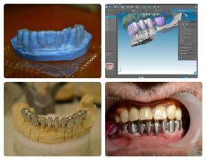 Οδοντοτεχνικό εργαστήριο Πειραιάς, οδοντοτεχνίτης Πειραιάς, ολικές οδοντοστοιχίες Πειραιάς, εμφυτεύματα Πειραιάς, υβριδικές οδοντοστοιχίες Πειραιάς, μασέλες Πειραιάς, Κιοσεγιάν