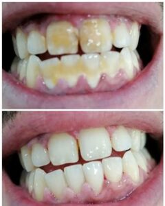 Χειρουργός Οδοντίατρος Πύργος, οδοντιατρείο Πύργος, εξαγωγή δοντιών Πύργος, απονευρώσεις δοντιών Πύργος, καθαρισμός δοντιών Πύργος, όψεις ρητίνης Πύργος, λεύκανση δοντιών Πύργος, σφράγισμα δοντιών Πύργος, Παρνασσά 