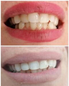 Χειρουργός Οδοντίατρος Πύργος, οδοντιατρείο Πύργος, εξαγωγή δοντιών Πύργος, απονευρώσεις δοντιών Πύργος, καθαρισμός δοντιών Πύργος, όψεις ρητίνης Πύργος, λεύκανση δοντιών Πύργος, σφράγισμα δοντιών Πύργος, Παρνασσά 